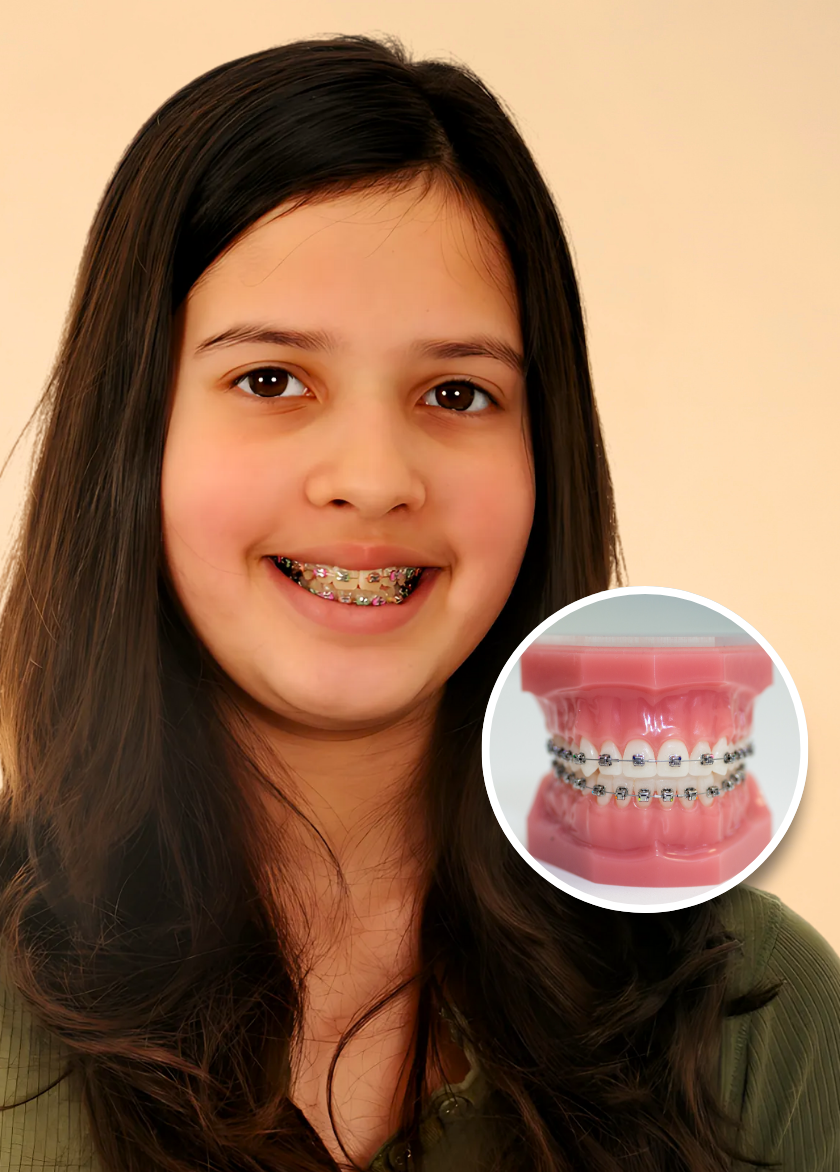 Braces-Treatment